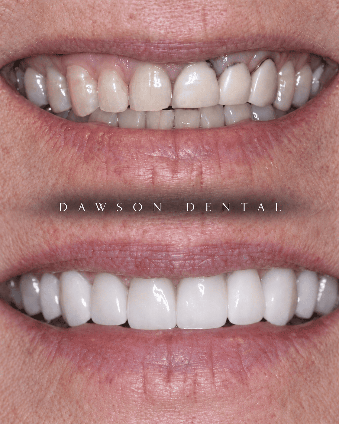 Before and after smile transformation completed at Dawson Dental in Peoria, Arizona