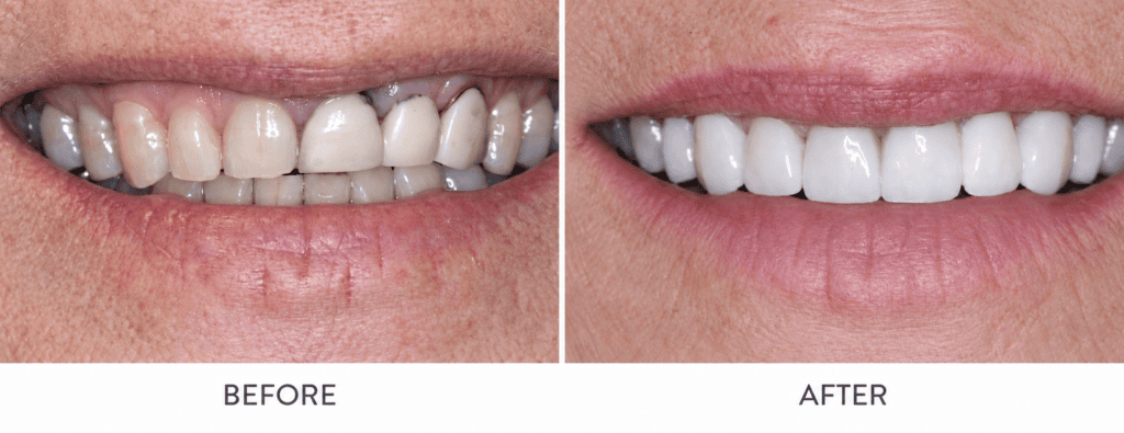 Before and after smile restored with aesthetic crowns and a dental bridge at Dawson Dental