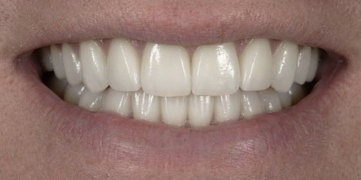After porcelain veneer treatment showing a restored natural-looking smile at Dawson Dental