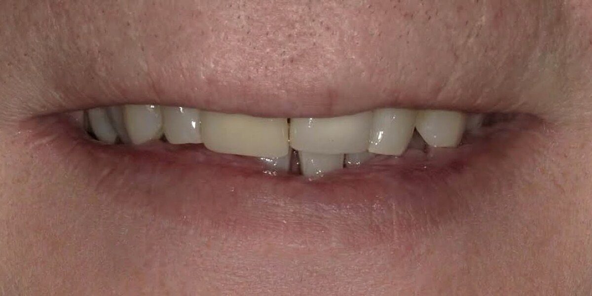 Before porcelain veneer treatment showing worn and uneven front teeth at Dawson Dental
